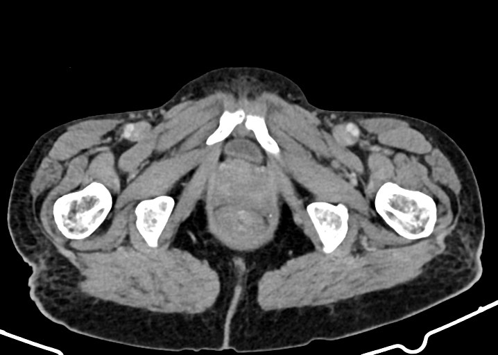 Acute small bowel (ileal) volvulus (Radiopaedia 71740-82139 Axial C+ portal venous phase 205).jpg