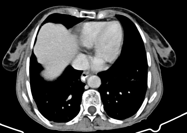 Acute small bowel (ileal) volvulus (Radiopaedia 71740-82139 Axial C+ portal venous phase 34).jpg