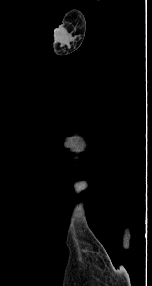 Acute small bowel (ileal) volvulus (Radiopaedia 71740-82139 Sagittal C+ portal venous phase 155).jpg