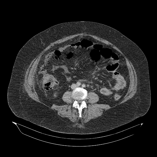Acute superior mesenteric artery occlusion (Radiopaedia 51288-56960 Axial C+ portal venous phase 58).jpg