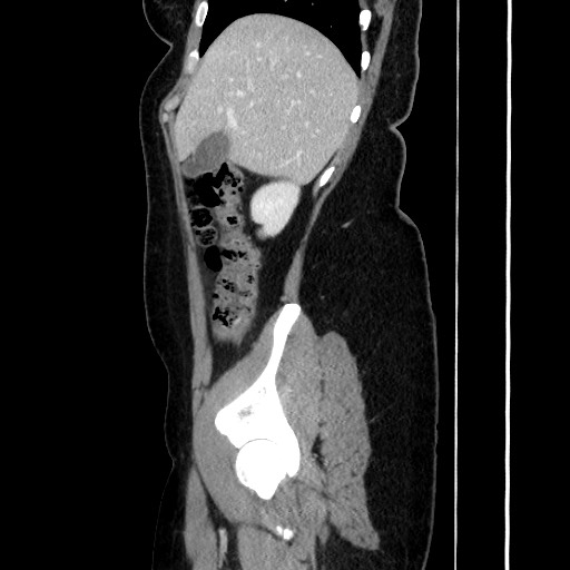 File:Acute uncomplicated appendicitis (Radiopaedia 73704-84499 Sagittal C+ portal venous phase 68).jpg