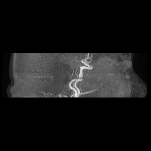 Acute vertebrobasilar ischemic infarction (Radiopaedia 25220-25474 Axial MRA 20).jpg