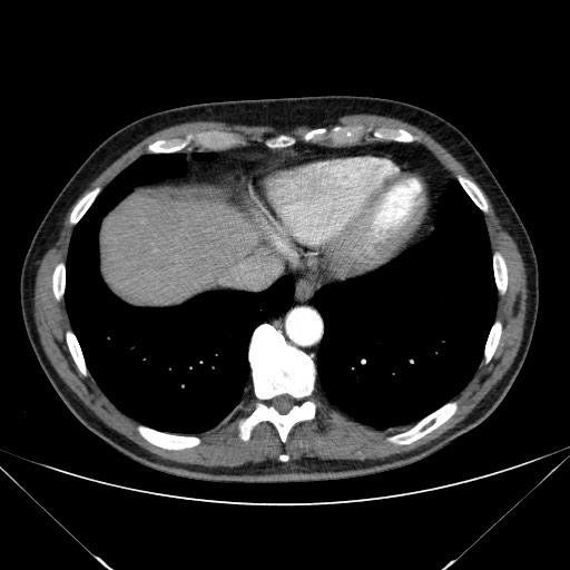 File:Adenocarcinoma of the lung (Radiopaedia 59871-67325 Axial C+ arterial phase 74).jpg