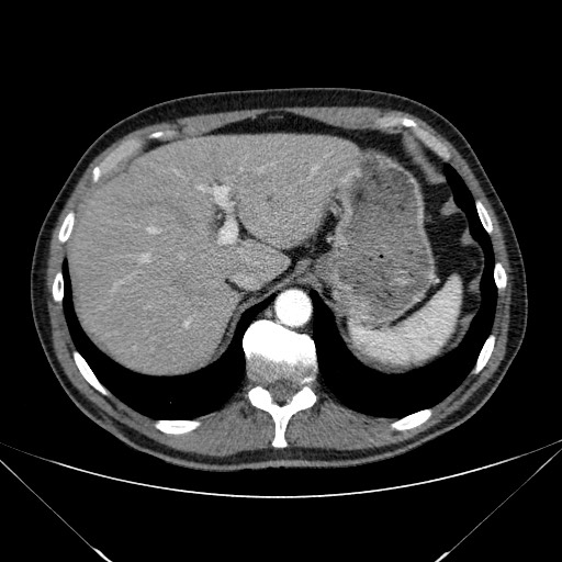 File:Adenocarcinoma of the lung (Radiopaedia 59871-67325 Axial C+ arterial phase 86).jpg