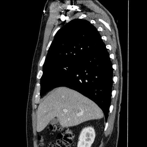 File:Adenocarcinoma of the lung (Radiopaedia 59871-67325 Sagittal C+ arterial phase 24).jpg