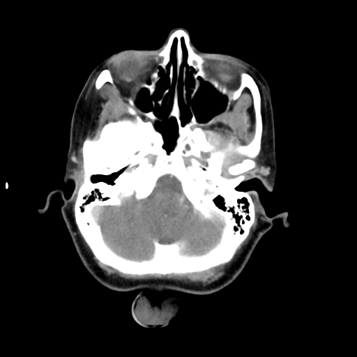 File:Adenoid cystic tumor of palate (Radiopaedia 46980-51518 Axial C+ delayed 17).png