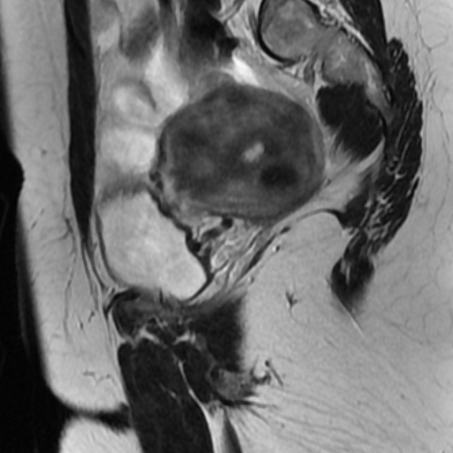 File:Adenoma malignum of cervix (Radiopaedia 66441-75705 Sagittal T2 5).jpg