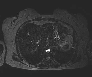 File:Adenomyomatosis of the gallbladder (Radiopaedia 50246-55587 Axial 3).png