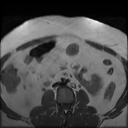 File:Adenomyosis within a didelphys uterus (Radiopaedia 70175-80215 Axial T1 3).jpg