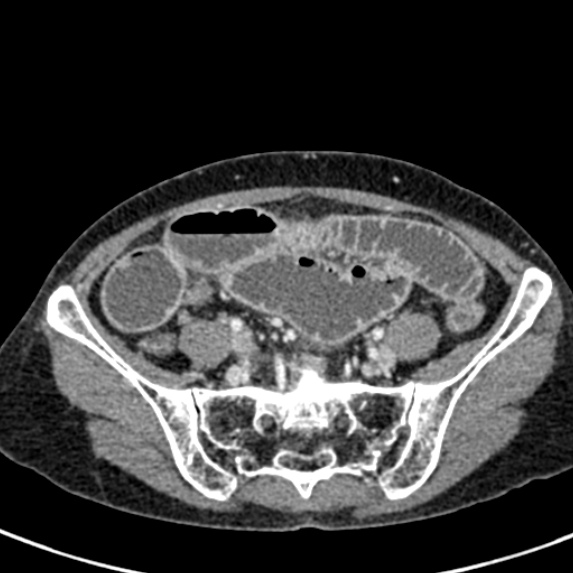 Adhesional small bowel obstruction (Radiopaedia 48397-53305 Axial C+ portal venous phase 67).jpg