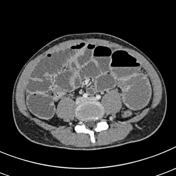 Adhesional small bowel obstruction (Radiopaedia 52107-57980 Axial C+ portal venous phase 79).jpg