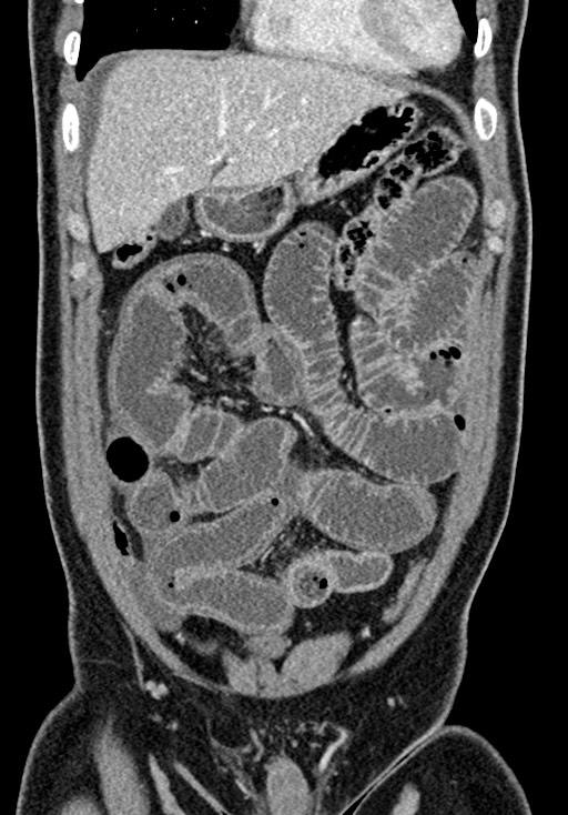 Adhesional small bowel obstruction (Radiopaedia 58900-66131 Coronal C+ portal venous phase 94).jpg