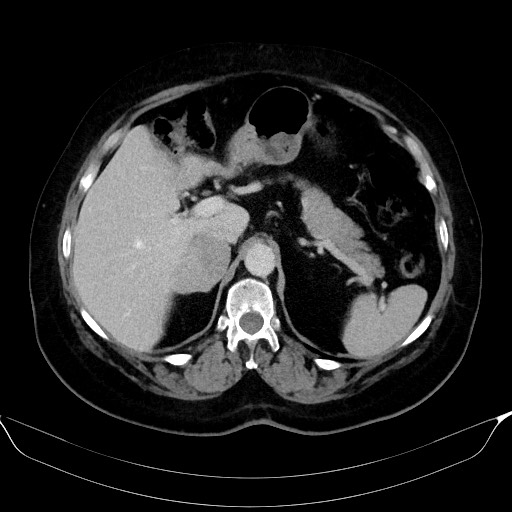 File:Adrenal cortical carcinoma (Radiopaedia 64017-72769 Axial C+ portal venous phase 18).jpg