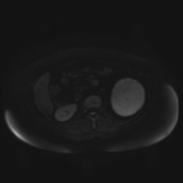 Adrenal cortical carcinoma (Radiopaedia 70906-81116 Axial DWI 46).jpg