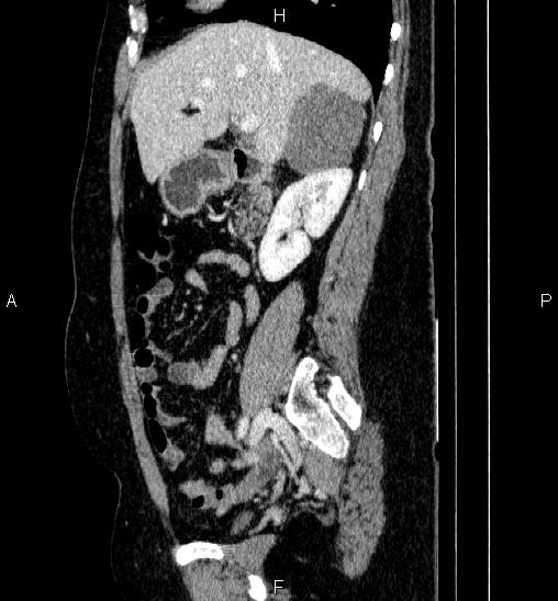 File:Adrenal cortical carcinoma (Radiopaedia 84882-100379 Sagittal C+ portal venous phase 32).jpg