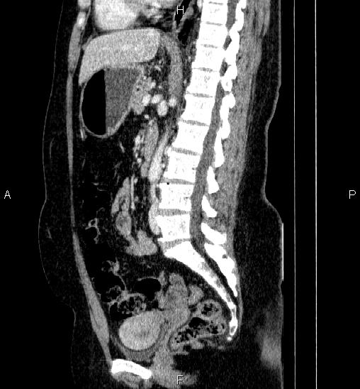 Adrenal cortical carcinoma (Radiopaedia 84882-100379 Sagittal C+ portal venous phase 47).jpg