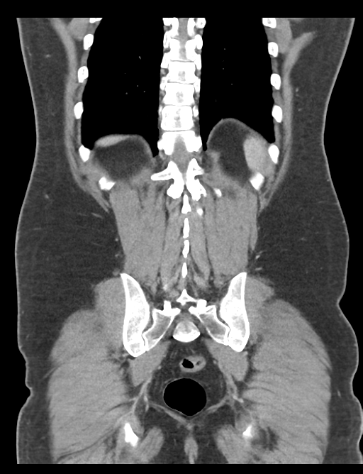 Adrenal cyst (Radiopaedia 45625-49777 Coronal C+ portal venous phase 56).png