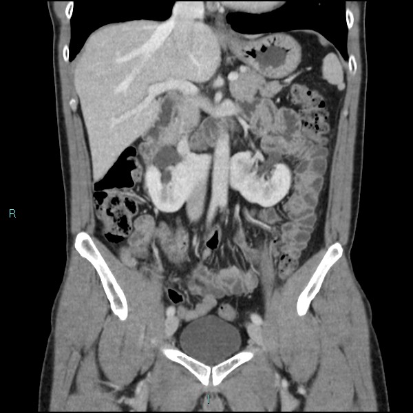 Adrenal cystic lymphangioma (Radiopaedia 83161-97534 Coronal C+ portal venous phase 33).jpg