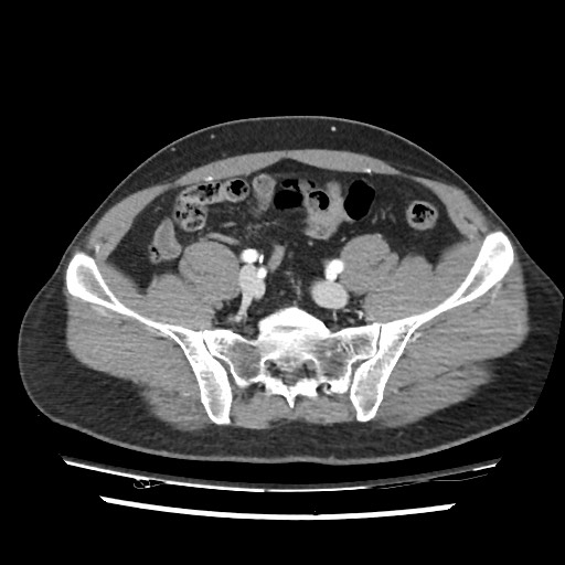 File:Adrenal gland trauma (Radiopaedia 81351-95078 Axial Dual bolus trauma C+ 100).jpg