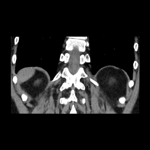 Adrenal gland trauma (Radiopaedia 81351-95079 Coronal non-contrast 72).jpg
