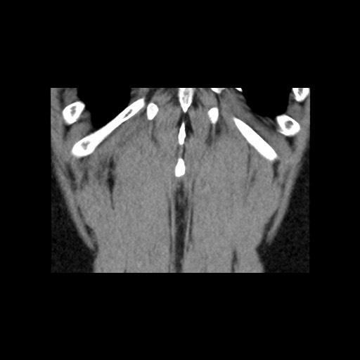 File:Adrenal gland trauma (Radiopaedia 81351-95079 Coronal non-contrast 81).jpg