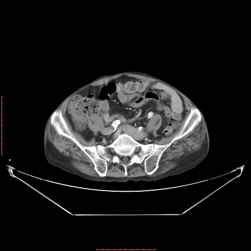 Adrenal hemangioma (Radiopaedia 68923-78668 Axial C+ portal venous phase 52).jpg