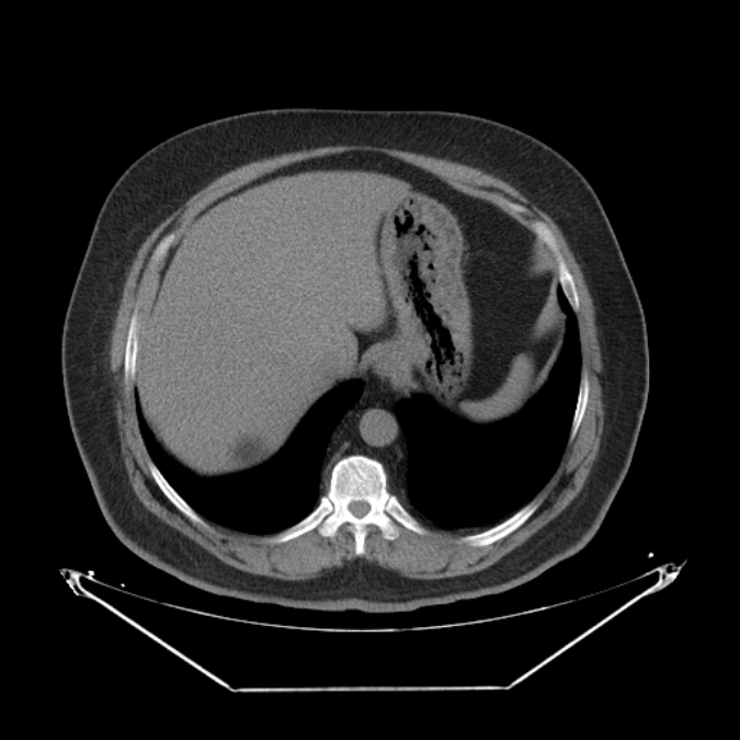Adrenal myelolipoma (Radiopaedia 26278-26407 Axial non-contrast 8).jpg