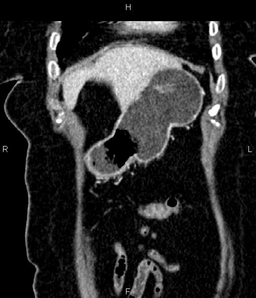 Adrenal myelolipoma (Radiopaedia 82742-96986 Coronal renal cortical phase 16).jpg