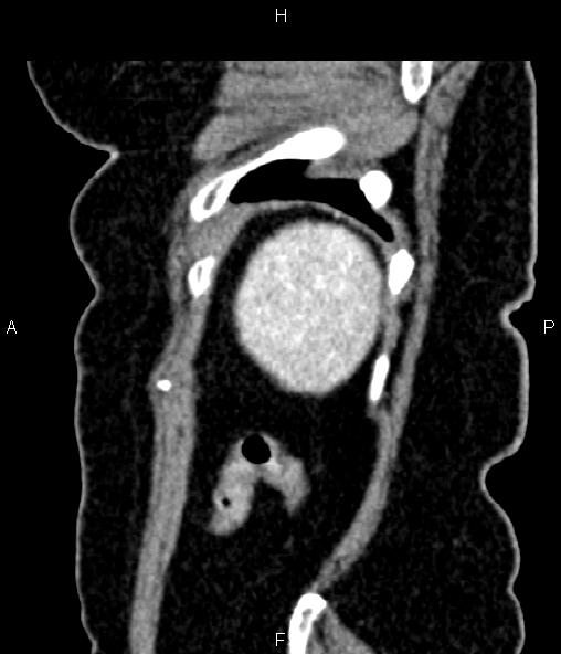 Adrenal myelolipoma (Radiopaedia 82742-96986 Sagittal renal cortical phase 96).jpg