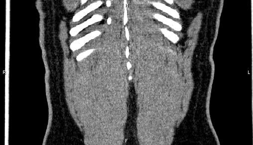 Adrenal myelolipoma (Radiopaedia 84321-99619 Coronal non-contrast 75).jpg