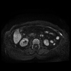 File:Adrenal myelolipoma - MRI (Radiopaedia 83249-97646 Axial DWI 20).jpg