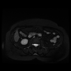 File:Adrenal myelolipoma - MRI (Radiopaedia 83249-97646 Axial STIR 25).jpg