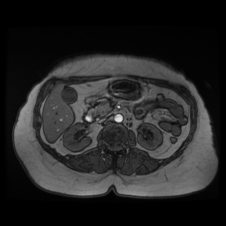 File:Adrenal myelolipoma - MRI (Radiopaedia 83249-97646 T1 out-of-phase 15).jpg