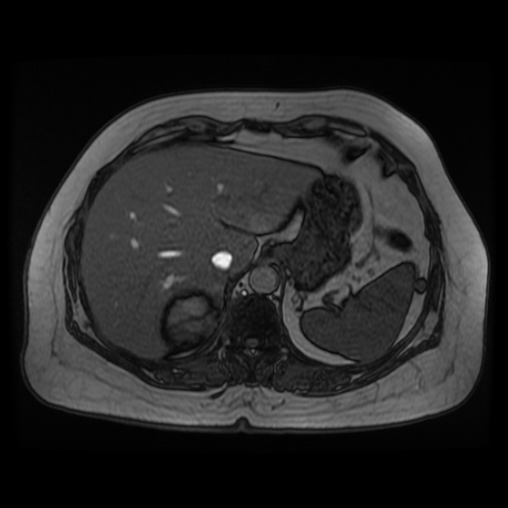 File:Adrenal myelolipoma - MRI (Radiopaedia 83249-97646 T1 out-of-phase 3).jpg