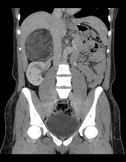 Adrenal myelolipoma - bilateral (Radiopaedia 74805-85810 Coronal C+ portal venous phase 153).jpg