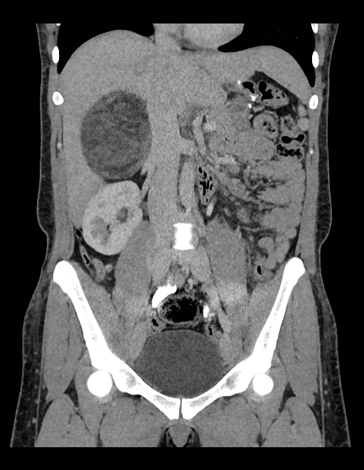 Adrenal myelolipoma - bilateral (Radiopaedia 74805-85810 Coronal C+ portal venous phase 164).jpg