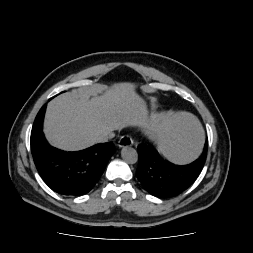 Adrenal myelolipoma and beaver tail liver (Radiopaedia 86201-102193 Axial non-contrast 43).jpg