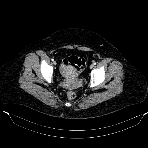 File:Afferent loop syndrome - secondary to incarcerated trocar site hernia (Radiopaedia 82959-97305 Axial C+ portal venous phase 213).jpg
