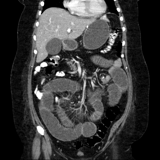 File:Afferent loop syndrome - secondary to incarcerated trocar site hernia (Radiopaedia 82959-97305 Coronal C+ portal venous phase 63).jpg