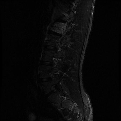 File:Aggressive vertebral hemangioma with pathological fracture (Radiopaedia 69528-79411 Sagittal STIR 1).jpg