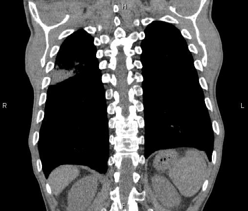 Air bronchogram in pneumonia (Radiopaedia 85719-101512 Coronal non-contrast 48).jpg