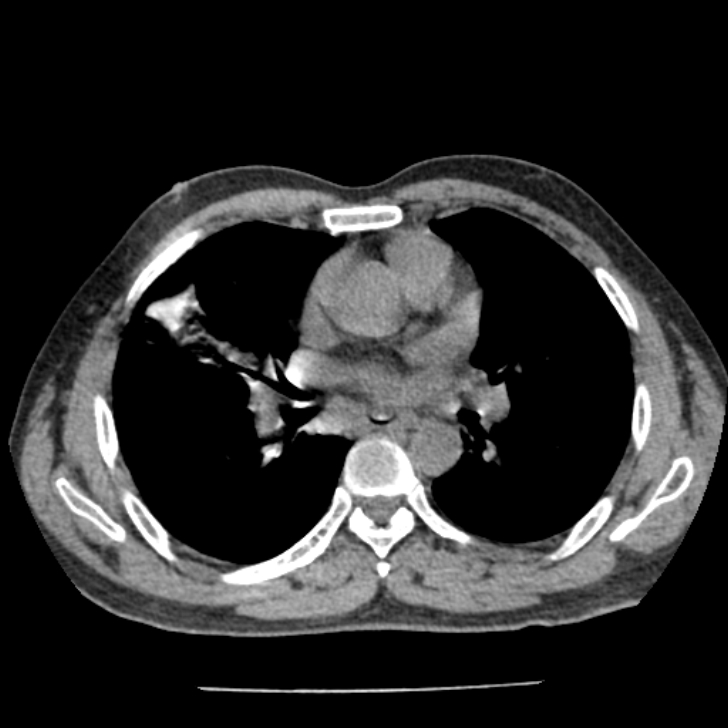 Airway foreign body in adult (Radiopaedia 85907-101779 Axial liver window 90).jpg