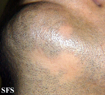 Alopecia Areata (Dermatology Atlas 11).jpg