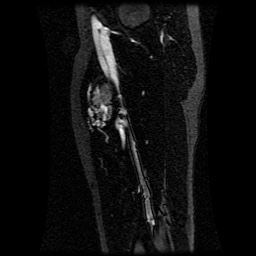 Alveolar soft part sarcoma (Radiopaedia 64501-73678 D 56).jpg