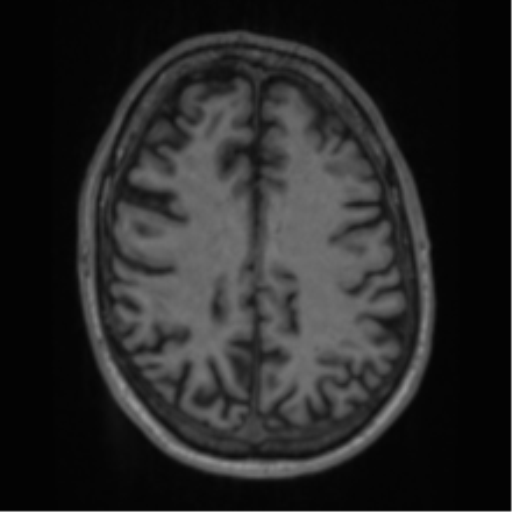 File:Alzheimer's disease- with apraxia (Radiopaedia 54763-61011 Axial T1 52).png