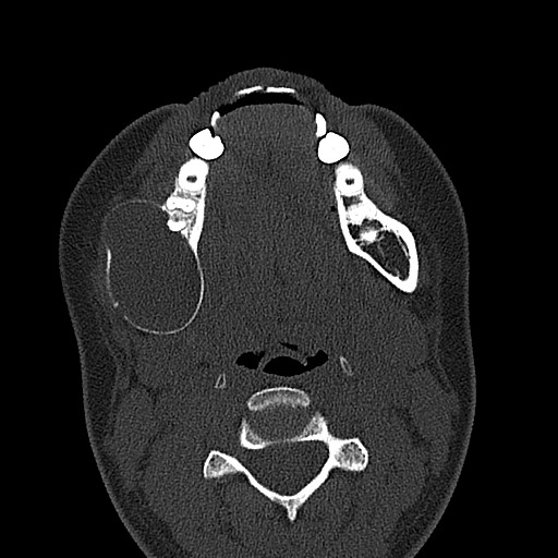 File:Ameloblastoma (Radiopaedia 26645-26793 E 33).jpg