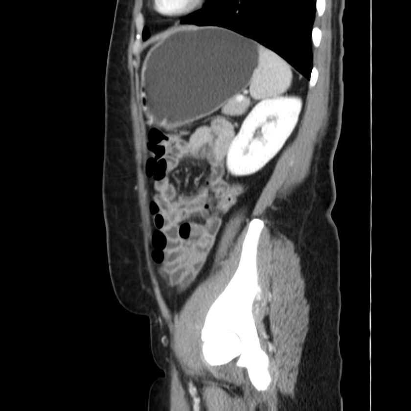 Ampullary tumor (Radiopaedia 22787-22816 D 42).jpg