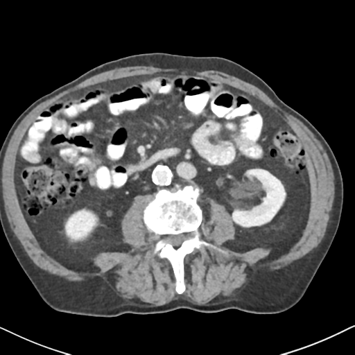 File:Amyand hernia (Radiopaedia 39300-41547 A 34).png