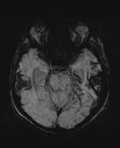 File:Amyloid angiopathy with inflammation (Radiopaedia 30360-31002 Axial SWI MIP 14).jpg