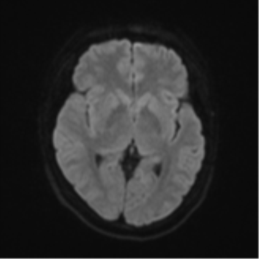 Anaplastic astroblastoma (Radiopaedia 55666-62194 Axial DWI 42).png